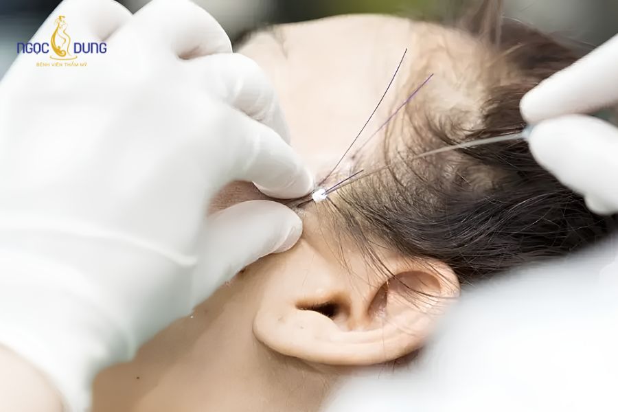 Căng da vùng thái dương: Phương pháp, bảng giá và quy trình 11 Căng chỉ thái dương là phương pháp được nhiều người lựa chọn