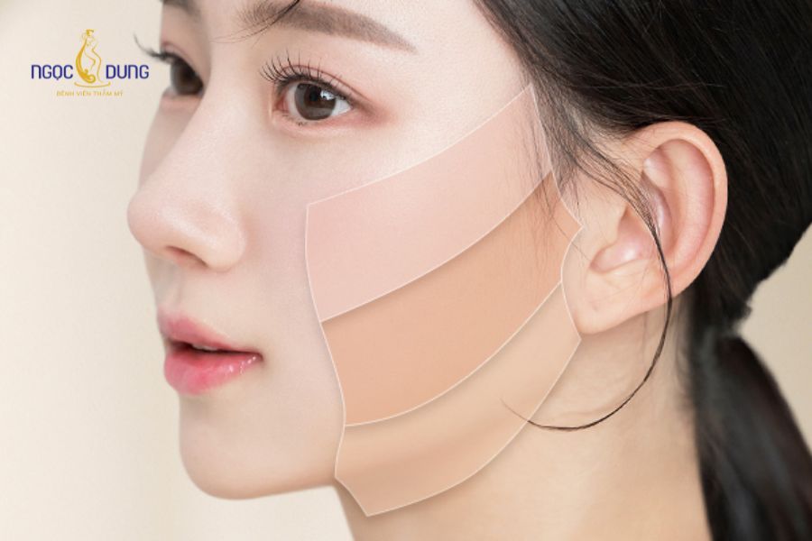 Căng da mặt mini là kỹ thuật phẫu thuật thẩm mỹ ít xâm lấn, tập trung xử lý vùng má dưới