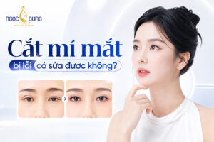 Cắt mí mắt bị lỗi