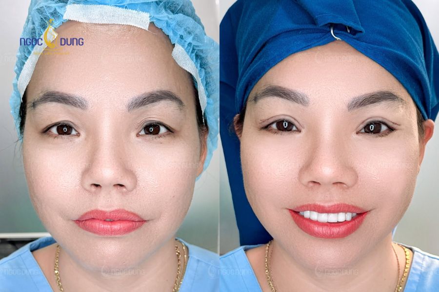 Cắt mí mắt trên là gì? Bảng giá, quy trình và điều cần biết 8 Cắt mí mắt trên bao nhiêu tiền phụ thuộc vào nhiều yếu tố