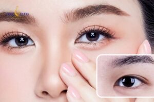 Cắt mí mắt trên là phẫu thuật thẩm mỹ vùng mắt, loại bỏ phần da chùng, mỡ thừa