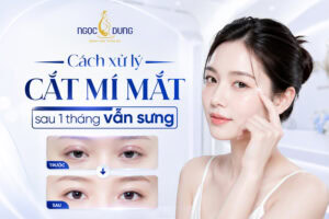 Cắt mí sau 1 tháng vẫn sưng