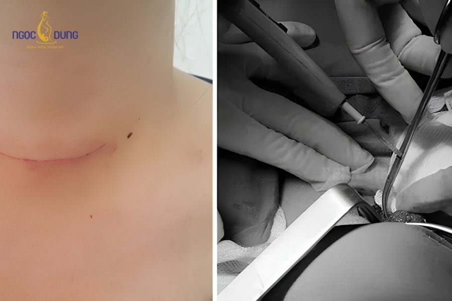 Phẫu thuật cắt sửa sẹo xấu: Các phương pháp và Quy trình 9 Cắt sửa sẹo xấu là kỹ thuật ngoại khoa loại bỏ mô sẹo, phục hồi bề mặt da