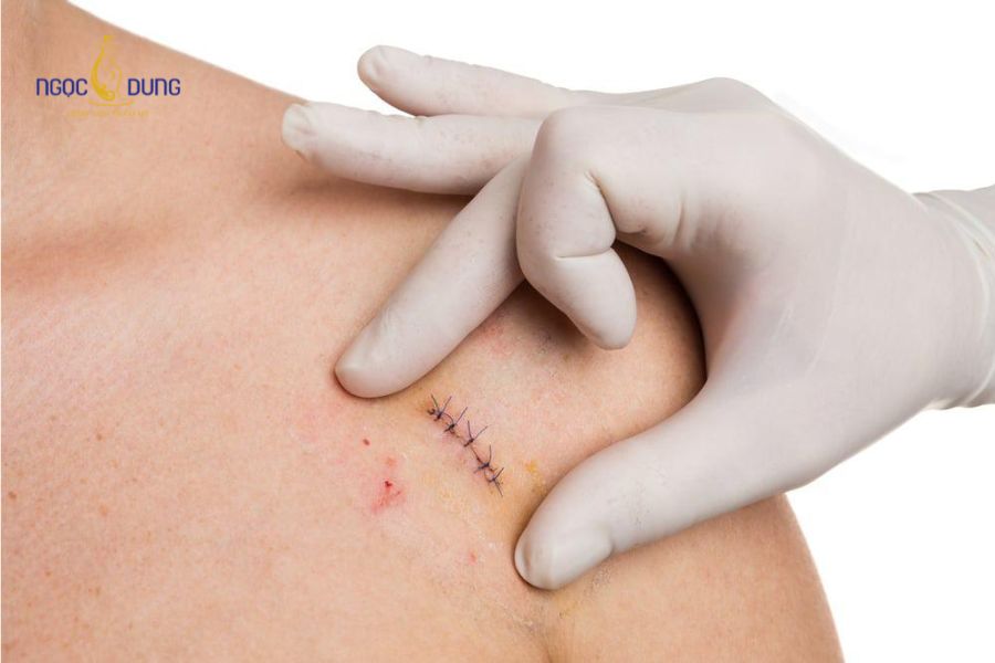 Phẫu thuật cắt sửa sẹo xấu: Các phương pháp và Quy trình 11 Cắt sửa sẹo xấu thông thường và khâu thẩm mỹ là phương pháp phổ biến được nhiều người áp dụng