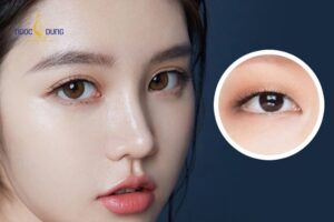 Cấy mỡ mí trên là kỹ thuật lấy mỡ tự thân tiêm vào vùng hốc mắt bị lõm