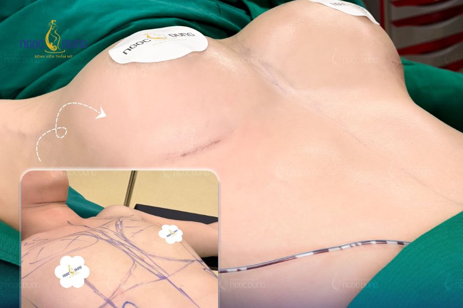 Nâng ngực bao lâu thì được nằm nghiêng? Tư thế ngủ chuẩn 11 Chất liệu túi độn gel cao cấp cùng kỹ thuật của Bác sĩ quyết định tốc độ hồi phục