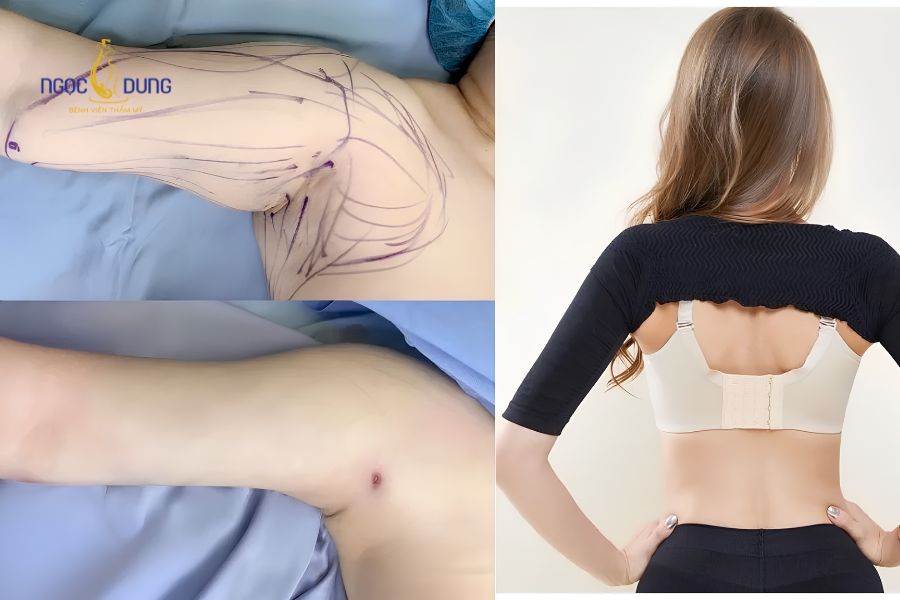 Hút mỡ bắp tay: Chi phí, quy trình và tiêu chí an toàn 14 Chế độ sinh hoạt và các bài tập vận động nhẹ nhàng sau khi hút mỡ bắp tay