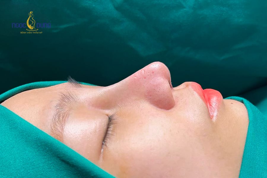 Nâng mũi sụn sườn: Ưu nhược điểm, bảng giá và quy trình 9 Chi phí đầu tư đối với nâng mũi sụn sườn thường cao hơn các phương pháp khác