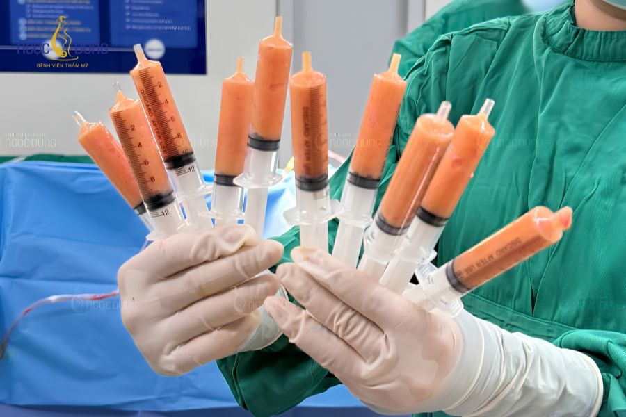 Nâng mông: Phương pháp phổ biến, bảng giá và an toàn 12 Chiết lọc ly tâm mỡ tự thân trước khi cấy vào vùng mông