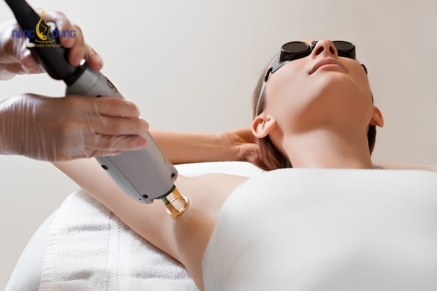 Điều trị tuyến mồ hôi: Phương pháp an toàn, dứt điểm 9 Chiếu chùm năng lượng laser hỗ trợ làm giảm khả năng bài tiết dịch vùng nách