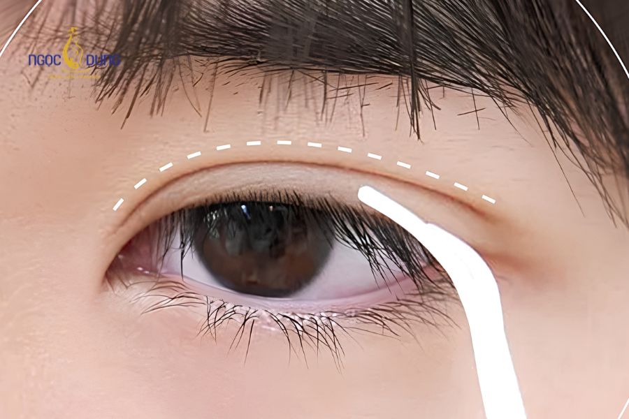 Phẫu thuật cắt mí laser: Thông tin cần biết từ A - Z 9 Cơ chế sử dụng chùm tia laser thay cho dao mổ cơ học truyền thống