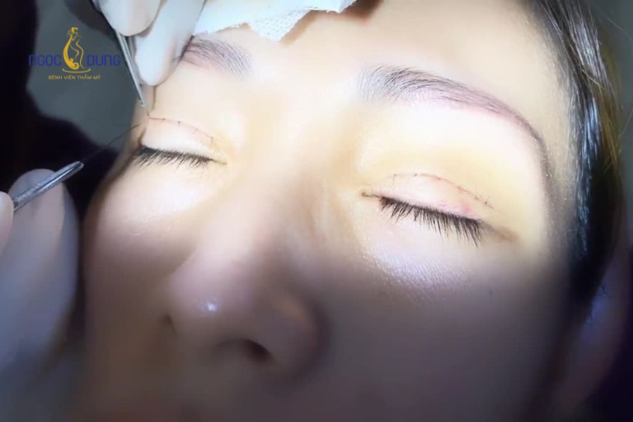Cắt mí bao nhiêu tiền? Tổng hợp bảng giá dịch vụ cắt mí mắt 12 Công nghệ áp dụng và tình trạng khuyết điểm của mắt là những yếu tố cấu thành nên tổng giá cắt mí mắt