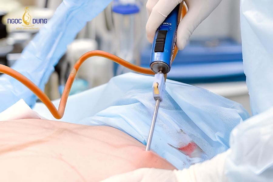Dịch vụ hút mỡ 1 vùng bụng dưới an toàn tại Ngọc Dung 16 Công nghệ hóa lỏng mỡ hiện đại giảm tối đa xâm lấn và tổn thương mô xung quanh