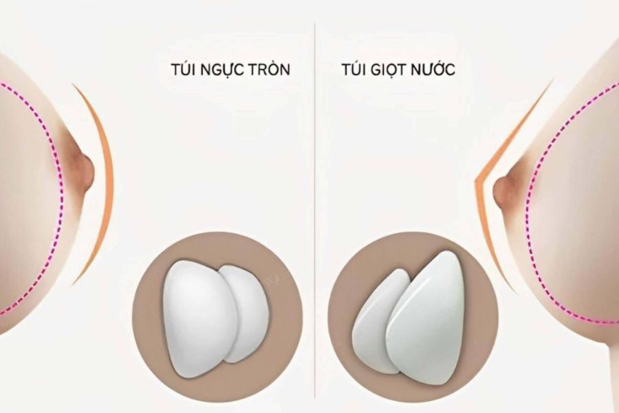 Nâng ngực nội soi túi tròn Mentor Xtra: Bảng giá cập nhật 19 Đánh giá độ võng lồng ngực để lựa chọn dung tích túi tiêu chuẩn phù hợp