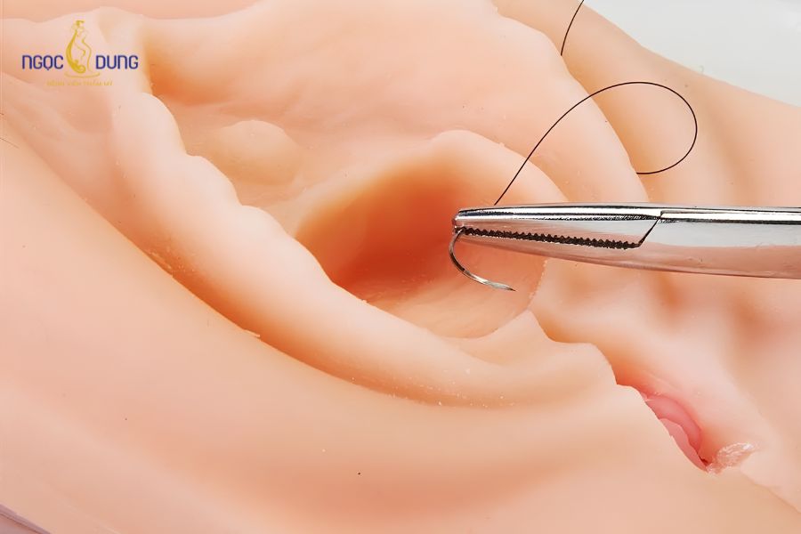 Cắt môi bé thừa: Có ảnh hưởng không, bao lâu thì lành 11 Đường khâu vi phẫu tỉ mỉ bằng chỉ siêu mảnh hạn chế tối đa sẹo lộ