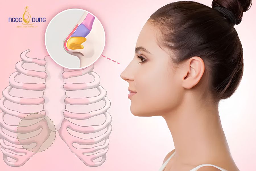 Nâng mũi sụn sườn: Ưu nhược điểm, bảng giá và quy trình 10 Giải đáp các thắc mắc thường gặp khi nâng mũi cấu trúc sụn sườn