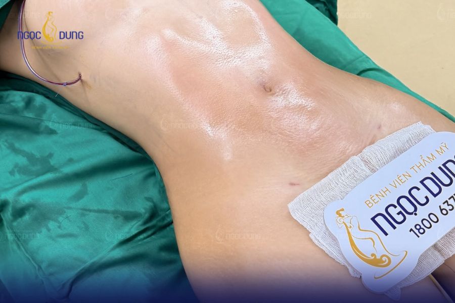 Hút mỡ bụng toàn phần: Bảng giá, quy trình cần biết 15 Hút mỡ bụng toàn phần an toàn khi được thực hiện tại cơ sở y tế được Bộ Y tế cấp phép