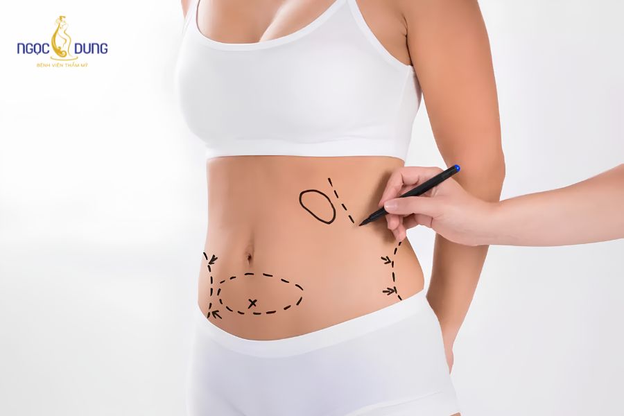 Hút mỡ bụng toàn phần: Bảng giá, quy trình cần biết 12 Hút mỡ bụng toàn phần là thủ thuật loại bỏ mỡ thừa diện rộng vùng bụng và hông eo