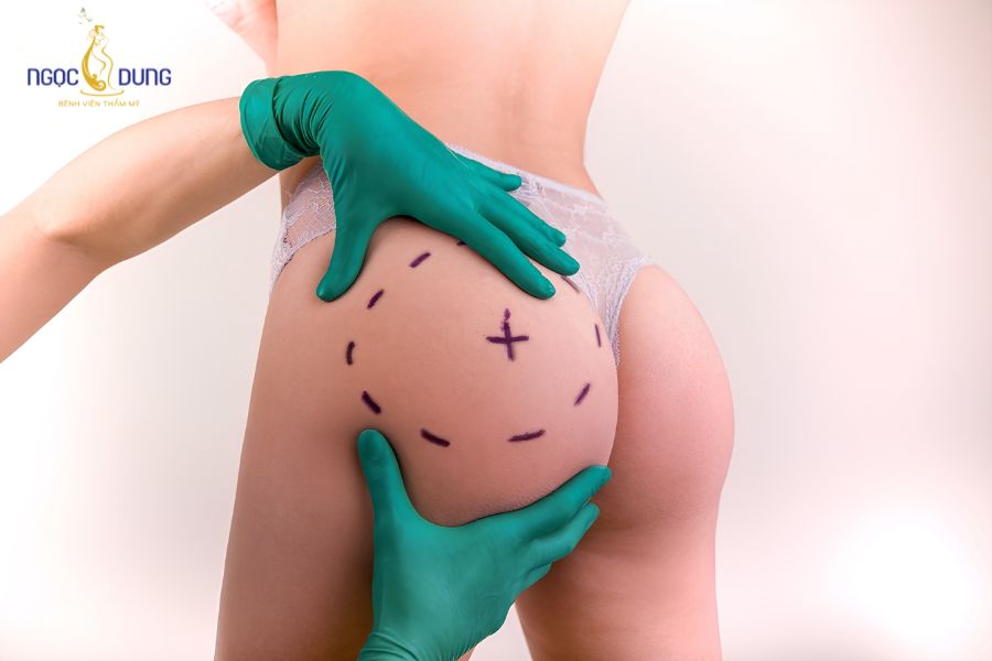 Hút mỡ mông là gì? Giá bao nhiêu? Quy trình an toàn 10 Hút mỡ mông tập trung vào việc giảm thể tích mỡ dư, giúp vòng 3 gọn và săn hơn thay vì tăng kích thước