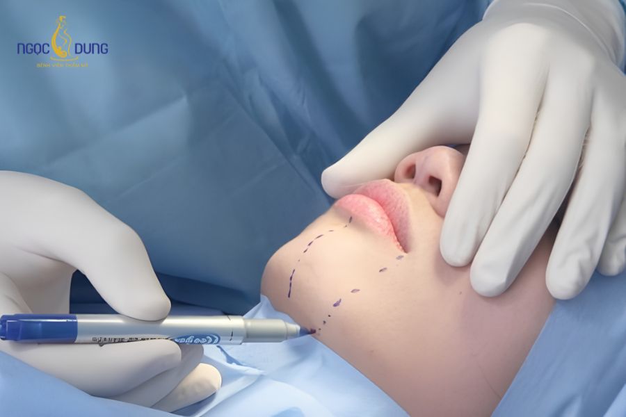 Hút mỡ nọng cằm: Thon gọn mặt chuẩn y khoa, Ngọc Dung 11 Hút mỡ nọng cằm là thủ thuật ngoại khoa loại bỏ lớp mỡ thừa tích tụ dưới cằm và vùng cổ trên