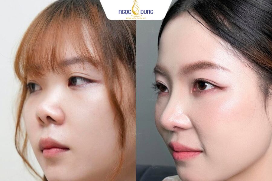 Phẫu thuật sửa mũi cũ, mũi lỗi: dấu hiệu và phương pháp 13 Kết quả nâng mũi tại Bệnh Viện Thẩm Mỹ Ngọc Dung