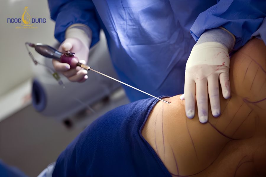 Hút mỡ bụng: Bảng giá, có nguy hiểm không và quy trình 8 Khách hàng an tâm phẫu thuật nhờ phòng ốc bảo đảm vô trùng khắt khe