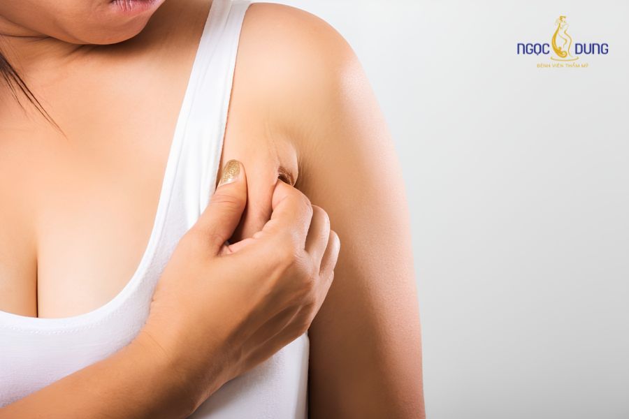 Hút mỡ nách bao nhiêu tiền? Quy trình thực hiện an toàn 13 Khách hàng gặp khuyết điểm mô mỡ nách chùng dày tích tụ lâu năm nhận tư vấn
