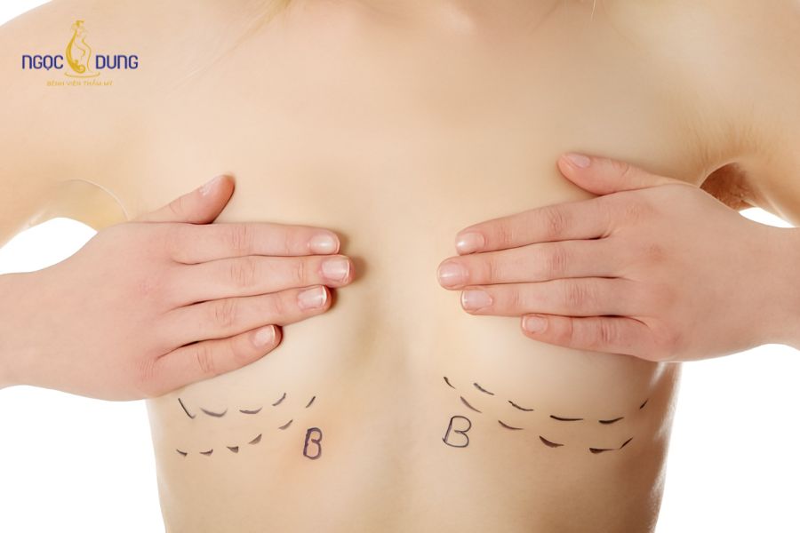 Nâng ngực nội soi túi Nano: Bảng giá, quy trình chuẩn 15 Khách hàng gặp tình trạng vòng 1 khiêm tốn nhận tư vấn phác đồ từ bác sĩ
