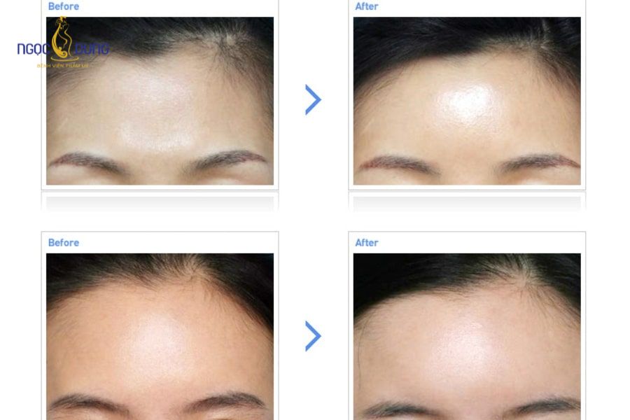 Cấy mỡ hõm trán là gì? Bảng giá và quy trình an toàn 15 Khách hàng nhận bảng tư vấn chi phí cấy mỡ trán rõ ràng