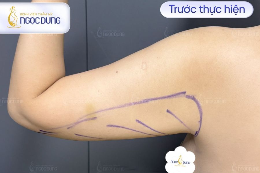 Hút mỡ nách bao nhiêu tiền? Quy trình thực hiện an toàn 11 Khách hàng nhận bảng tư vấn chi phí hút mỡ nách minh bạch từ chuyên gia