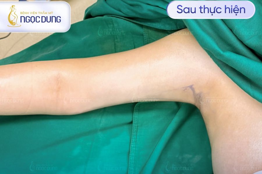 Hút mỡ nách bao nhiêu tiền? Quy trình thực hiện an toàn 12 Khách hàng thoải mái trong suốt ca phẫu thuật nhờ công nghệ gây mê chuẩn y khoa