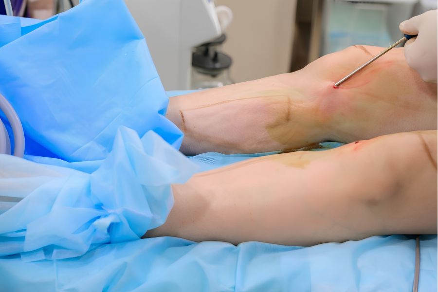 Hút mỡ bắp chân: Giải pháp gọn an toàn tại Ngọc Dung 11 Khi thực hiện đúng quy trình y khoa, hút mỡ bắp chân là thủ thuật an toàn