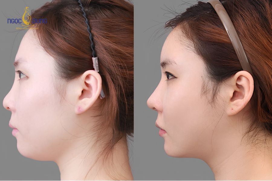 Hút mỡ nọng cằm: Thon gọn mặt chuẩn y khoa, Ngọc Dung 13 Khuôn mặt thon gọn, đường viền hàm sắc nét sau khi loại bỏ mỡ cằm đôi