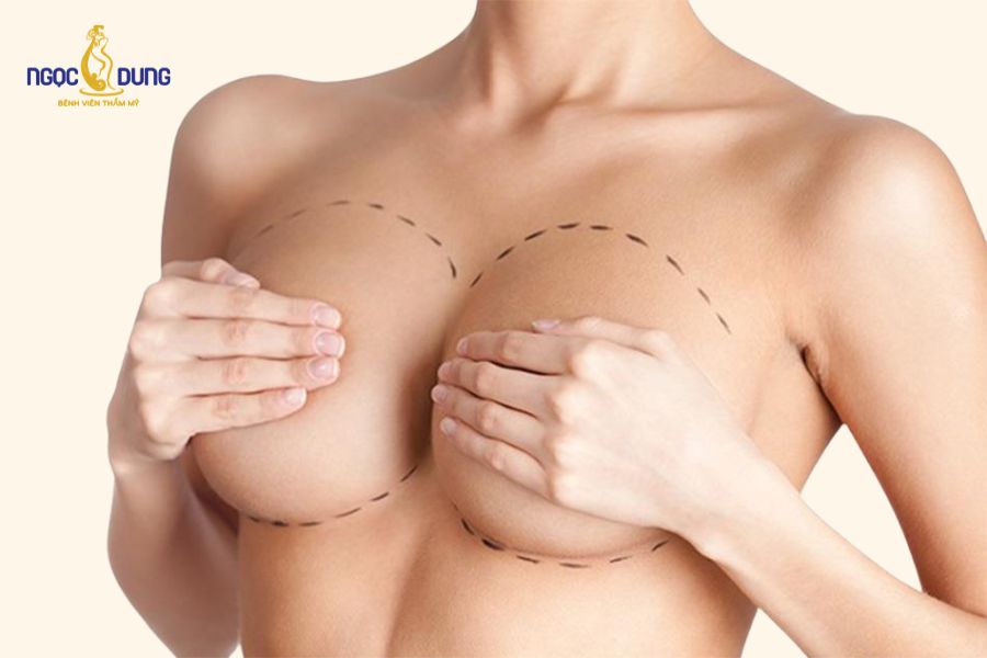 Nâng ngực nội soi túi tròn, vòng 1 căng mềm tự nhiên 13 Khuôn ngực đầy đặn, căng tròn cân xứng hai bên sau khi đặt túi