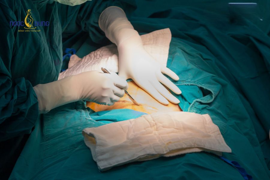 Phẫu thuật cắt sửa sẹo xấu: Các phương pháp và Quy trình 15 Kiểm soát tình trạng nhiễm trùng bằng quy trình vô trùng nghiêm ngặt trong phẫu thuật