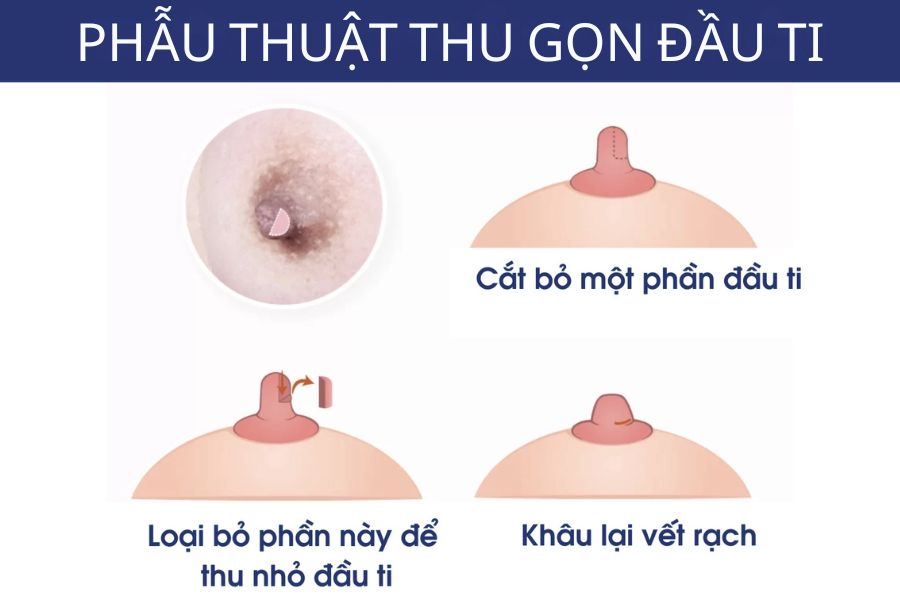 Thu gọn đầu ti: Bảng giá, phương pháp và quy trình 8 Kỹ thuật can thiệp mô thừa nhằm thu nhỏ kích thước núm vú