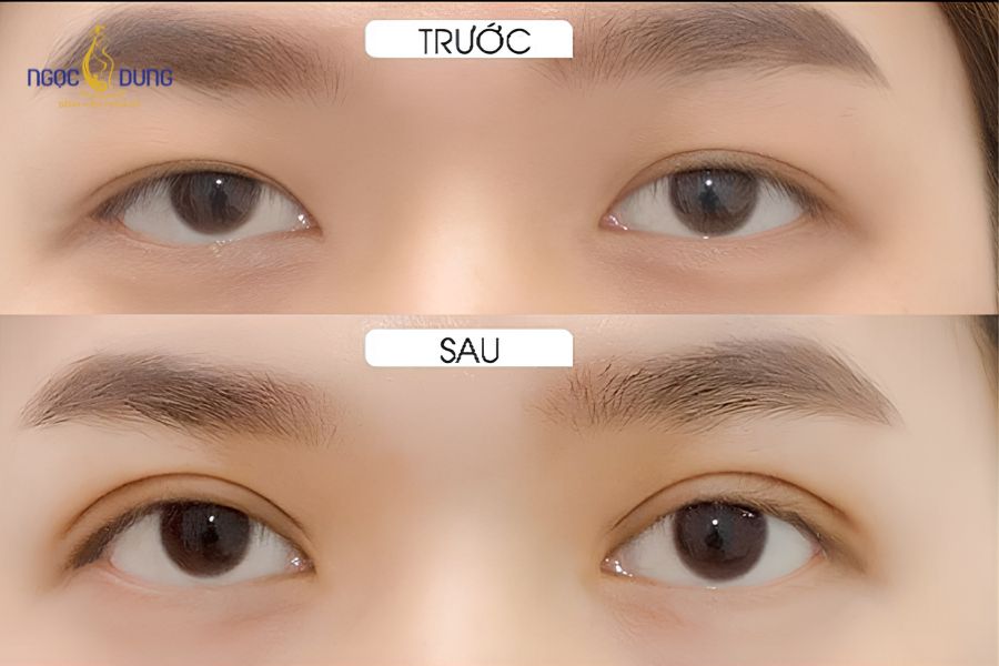 Cắt mí bao nhiêu tiền? Tổng hợp bảng giá dịch vụ cắt mí mắt 8 Kỹ thuật cắt mí mini với đường rạch siêu nhỏ, giúp hạn chế sưng nề tối đa