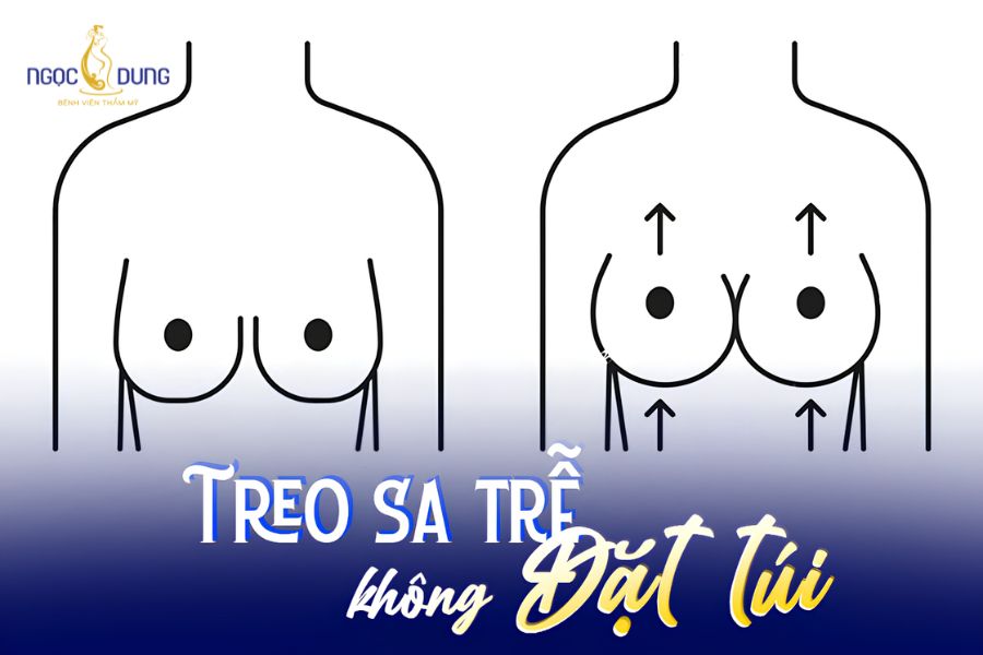 Nâng ngực sa trễ: Phân loại, phương pháp và bảng giá 18 Kỹ thuật cuộn mô tuyến nâng bầu ngực không sử dụng túi độn nhân tạo