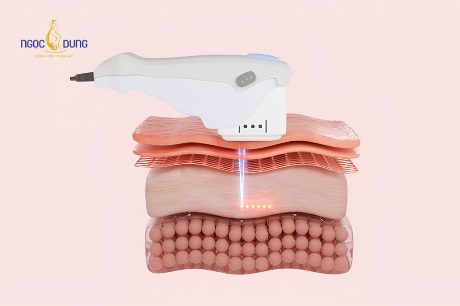 Dịch vụ hút mỡ 1 vùng bụng dưới an toàn tại Ngọc Dung 17 Kỹ thuật hút mỡ bằng sóng siêu âm hóa lỏng trước khi hút ra ngoài