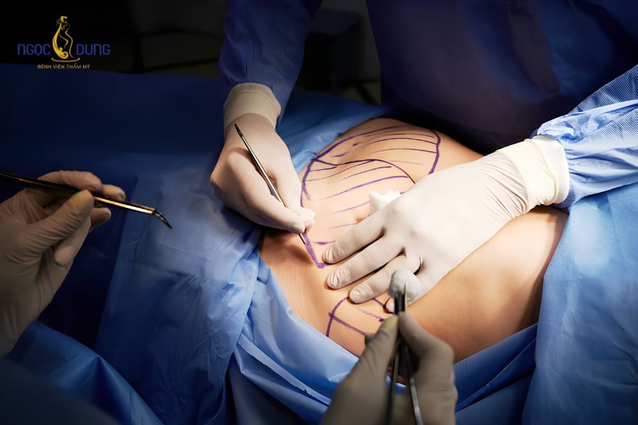 Hút mỡ bụng: Bảng giá, có nguy hiểm không và quy trình 9 Kỹ thuật ngoại khoa bóc tách và đào thải mô mỡ vùng bụng qua ống cannula siêu mảnh