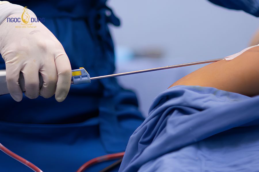 Hút mỡ bắp chân: Giải pháp gọn an toàn tại Ngọc Dung 10 Kỹ thuật ngoại khoa bóc tách và loại bỏ mô mỡ thừa tích tụ vùng cẳng chân
