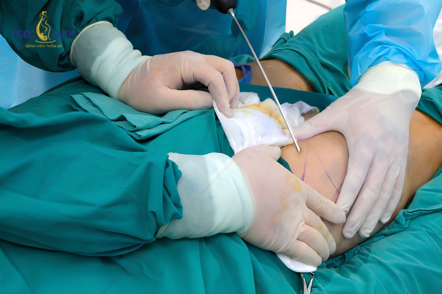 Hút mỡ đùi an toàn, hiệu quả chuẩn y khoa tại Ngọc Dung 10 Kỹ thuật ngoại khoa bóc tách và loại bỏ mô mỡ tích tụ vùng đùi qua ống cannula chuyên dụng