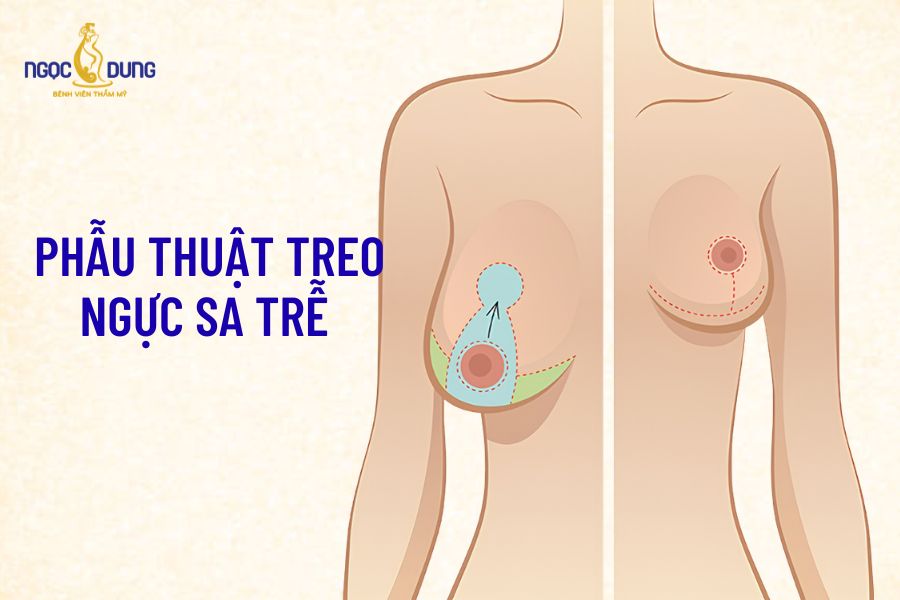 Phẫu thuật nâng ngực: Bảng giá, phương pháp và quy trình 12 Kỹ thuật phẫu thuật loại bỏ da chùng, định hình lại mô tuyến vú sa trễ