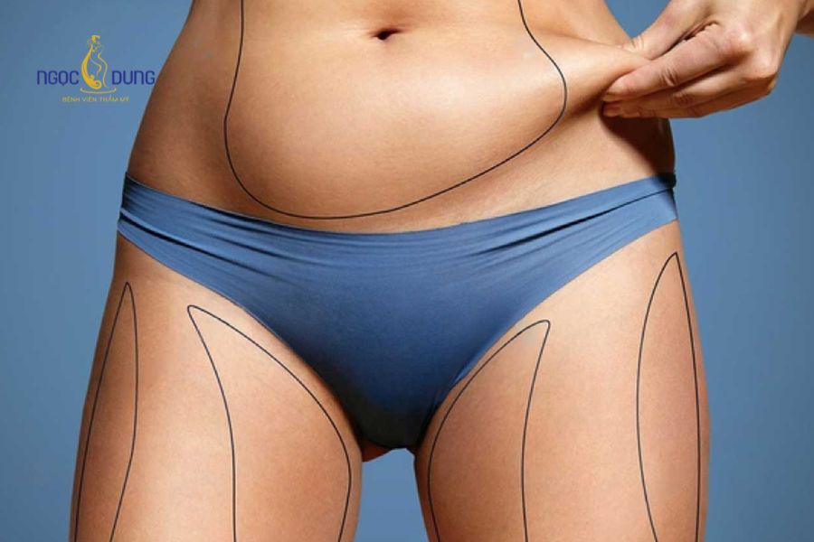 Cấy mỡ tự thân vùng bikini: Trẻ hóa toàn diện, an toàn 9 Kỹ thuật tiêm cấy vi mô mỡ tự thân vào các phân vùng khuyết hóp ở vùng kín