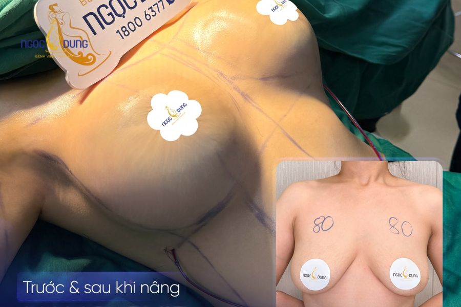 Có nên nâng ngực không? Lời khuyên từ chuyên gia Ngọc Dung 12 Lựa chọn cơ sở y tế được cấp phép giúp kiểm soát các nguy cơ tai biến