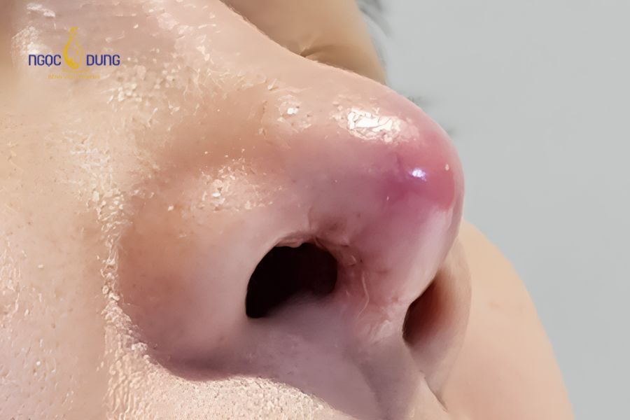 Phẫu thuật sửa mũi cũ, mũi lỗi: dấu hiệu và phương pháp 8 Mũi bị nhiễm trùng, sưng tấy, nóng đỏ và chảy dịch là biểu hiện của mũi bị lỗi sau khi nâng