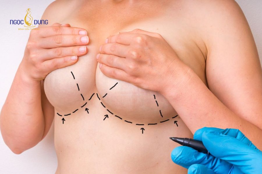Phẫu thuật nâng ngực: Bảng giá, phương pháp và quy trình 11 Nâng ngực bằng cấy mỡ tự thân mang lại nhiều ưu điểm