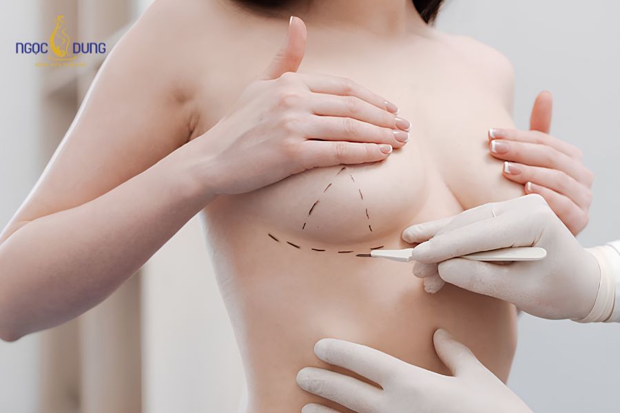 Nâng ngực bằng filler: Giá bao nhiêu, có an toàn không? 15 Nâng ngực nội soi sử dụng túi độn gel cao cấp mang lại dáng ngực căng tròn bền lâu