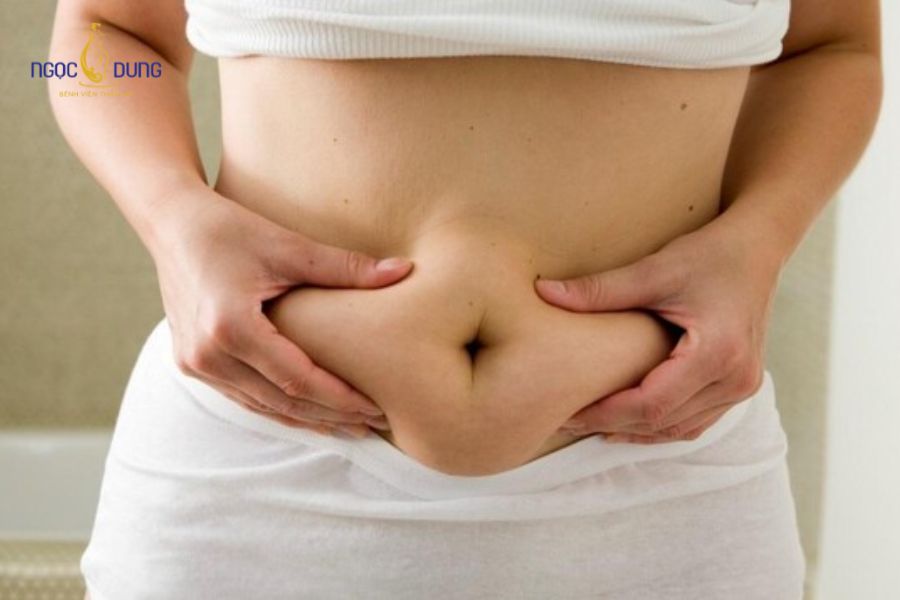 Hút mỡ bụng toàn phần: Bảng giá, quy trình cần biết 13 Người có vòng eo mất cân đối do mỡ tập trung nhiều ở bụng trên hoặc bụng dưới