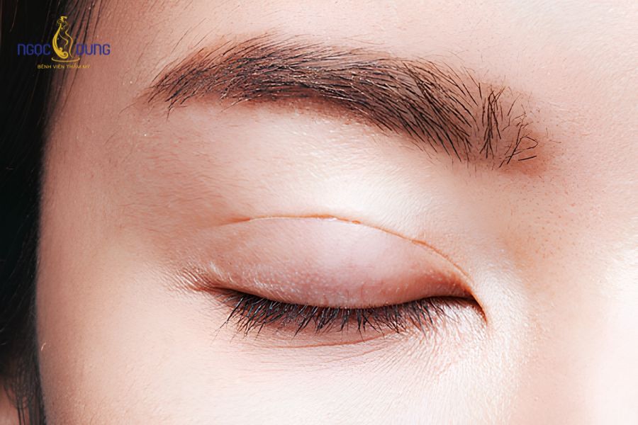 Cắt mí mắt trên là gì? Bảng giá, quy trình và điều cần biết 7 Những đối tượng nào nên thực hiện cắt mí mắt trên